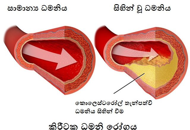 ඔබගේ කොලෙස්ටරෝල් මට්ටම අඩු කරගන්නේ කොහොමද